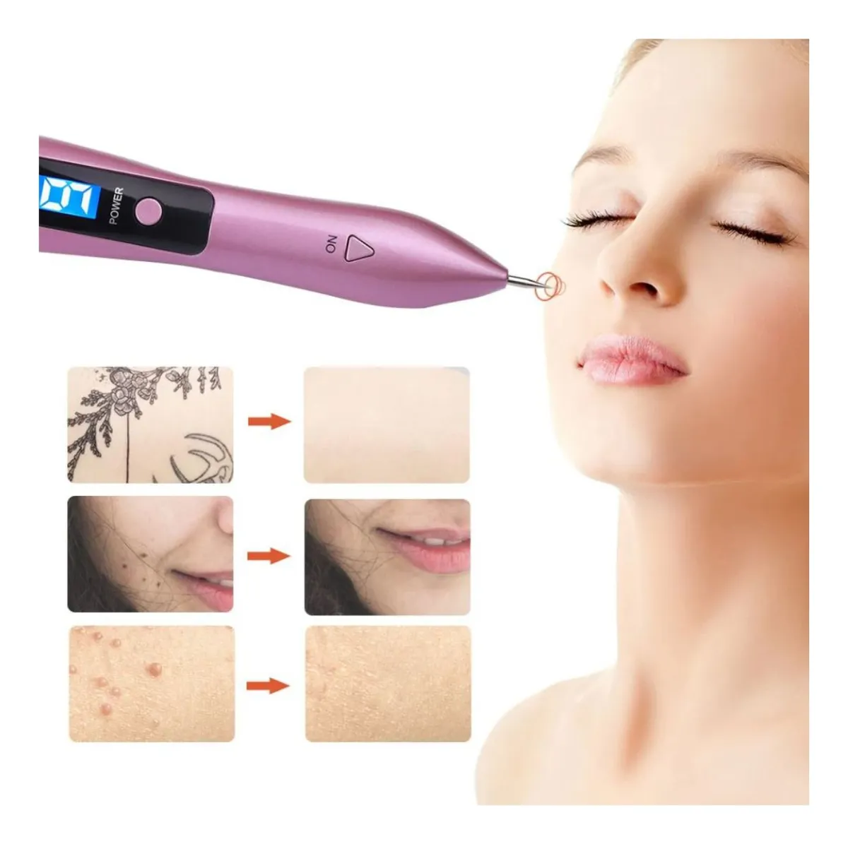 ¡DI ADIOS A LAS VERRUGAS DESDE CASA! BioCauter® 💥Cauterizador de verrugas + ENVIO GRATIS 🎁